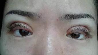 双眼皮失败的图片,揭秘术后修复关键