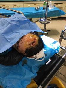 头住院照片,探寻住院患者头部损伤之谜